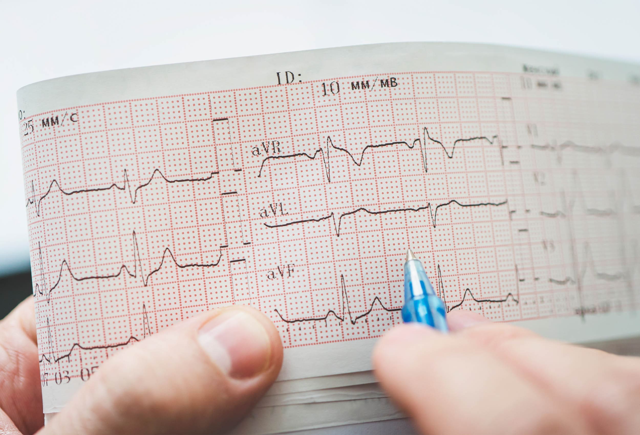 ECGs